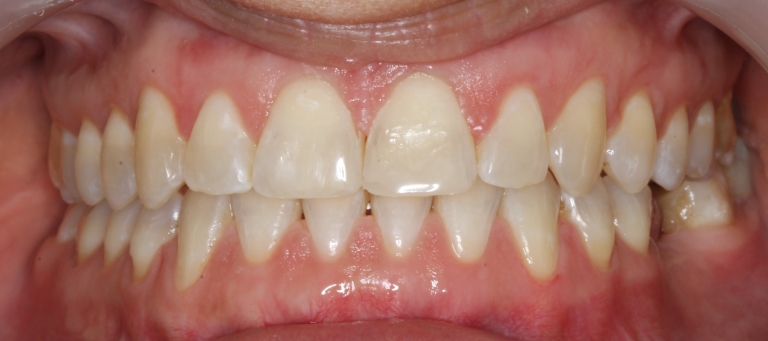 Poslije ortodontske terapije