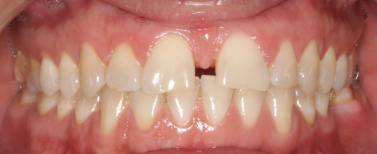 Ortodont Uravic_prije i poslijed