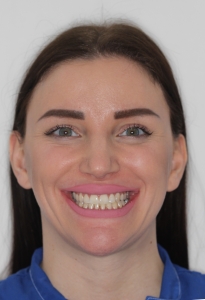 Ortodontska terapija_prije i poslijed