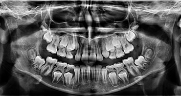Rendgensko snimanje u ortodonciji – sve što trebate znati