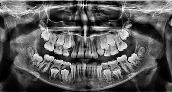 Rendgensko snimanje u ortodonciji – sve što trebate znati